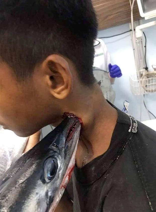 Un pez aguja atraviesa el cuello de un joven en Indonesia y este vive para contarlo