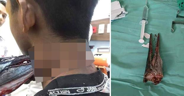 Un pez aguja atraviesa el cuello de un joven en Indonesia y este vive para contarlo