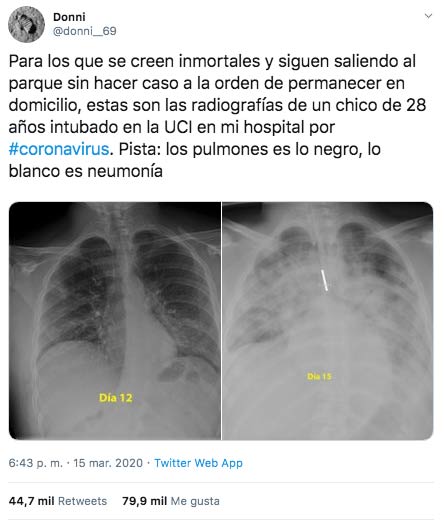 Para los que se creen inmortales y siguen saliendo, estas son las radiografías de un chico de 28 años intubado en la UCI