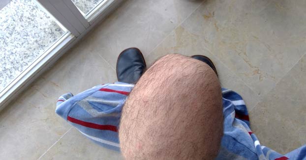 Un troll engaña al foro más importante de alopecia en España con fotos de sus rodillas