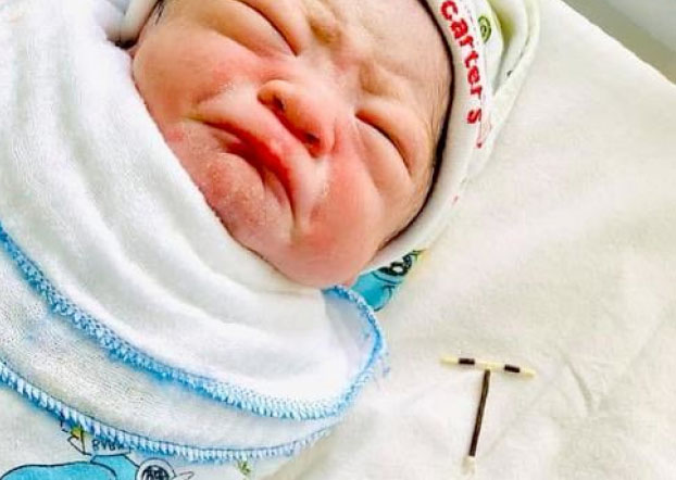 Un bebé nace agarrado al DIU que tenía implantado su madre