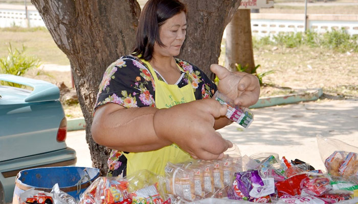 Una mujer que sufre macrodistrofia lipomatosa y tiene los brazos más grandes del mundo