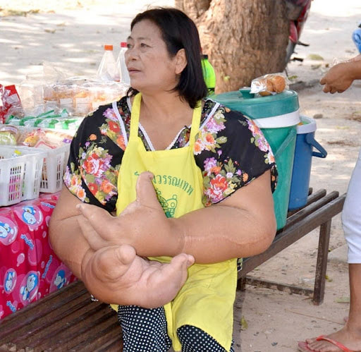 Una mujer que sufre macrodistrofia lipomatosa y tiene los brazos más grandes del mundo