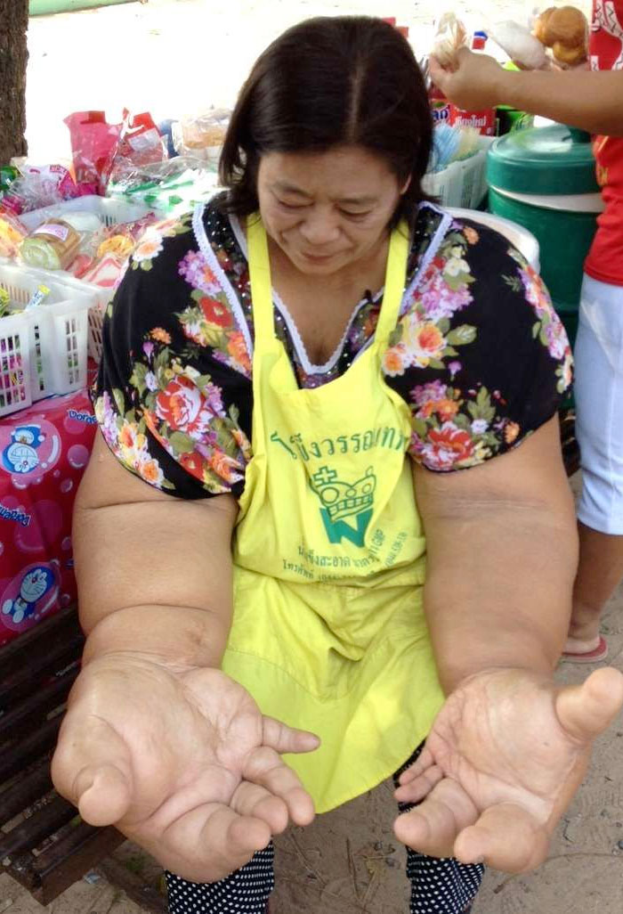 Una mujer que sufre macrodistrofia lipomatosa y tiene los brazos más grandes del mundo