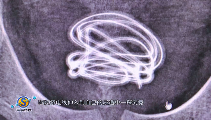 Un adolescente inserta un cable de 70 centímetros en su propia uretra porque quería saber de dónde proviene la orina