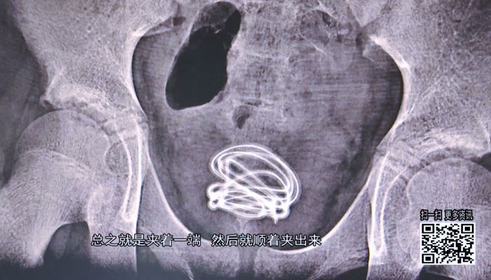 Un adolescente inserta un cable de 70 centímetros en su propia uretra porque quería saber de dónde proviene la orina