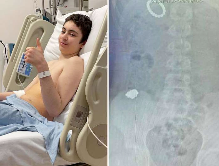 Un chaval de 12 años se traga 54 imanes para ver si se volvía magnético y tienen que operarlo de urgencia