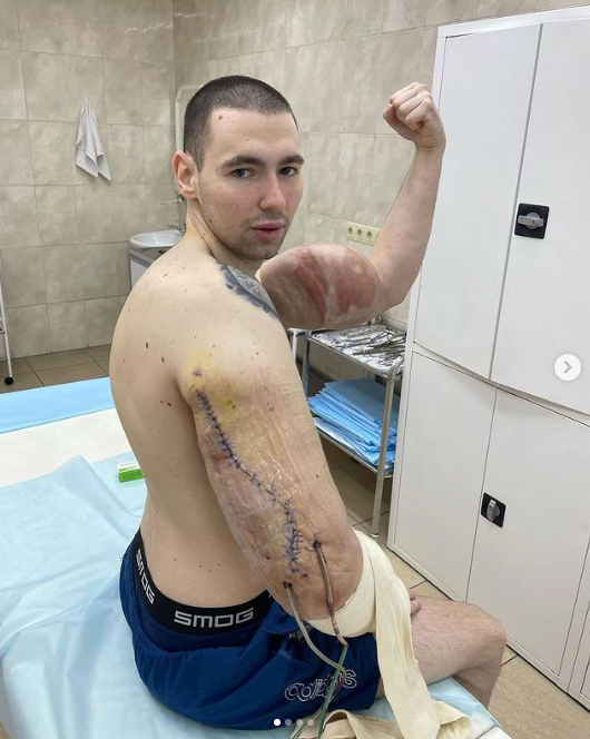 El 'Hulk ruso' muestra sus tríceps tras una segunda cirugía para extraer la mezcla casera que se inyectó para aumentar su volumen muscular