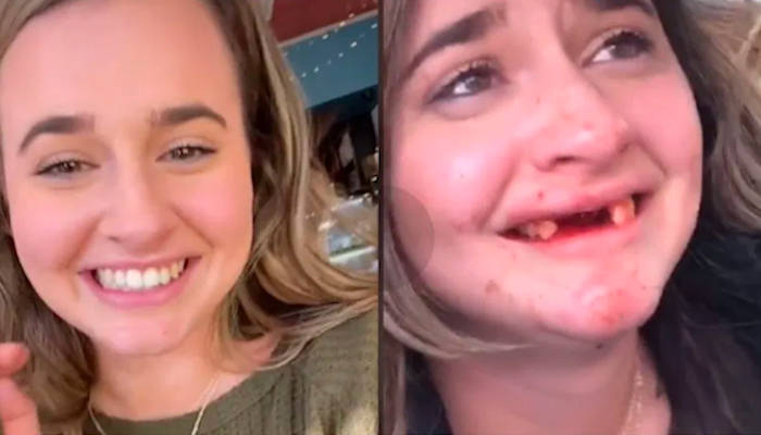 Una tiktoker se rompe los dientes tras hacer un absurdo reto viral tras beber alcohol