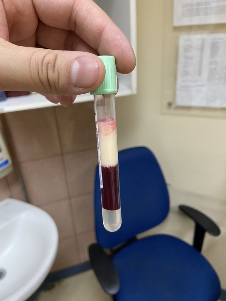Sangre de un paciente con 9000 mg/dl de triglicéridos