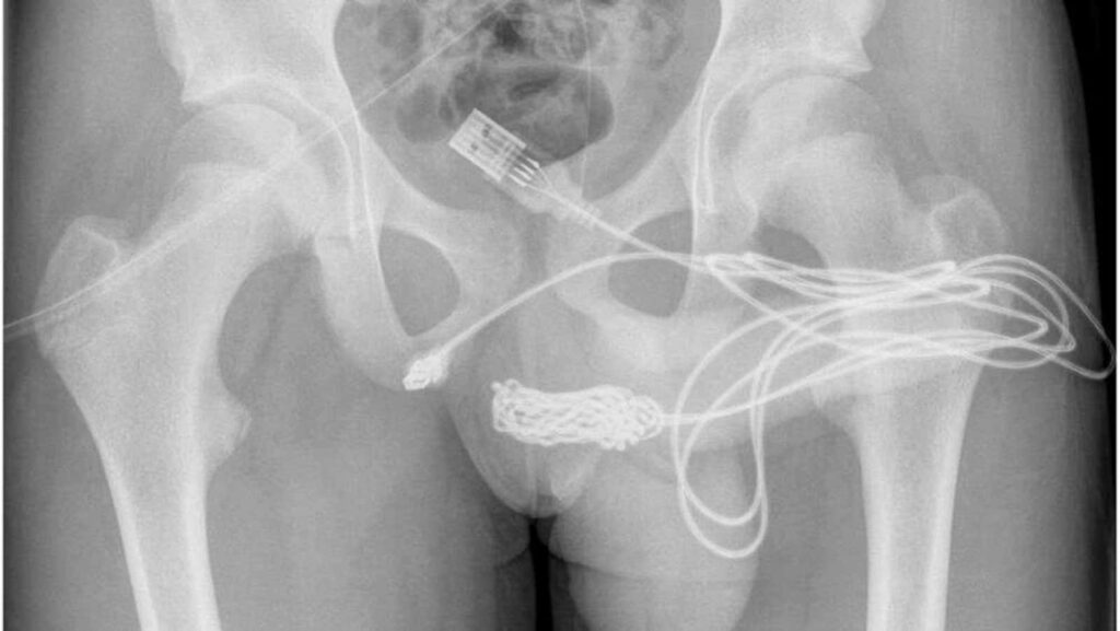 Un joven termina en urgencias después de intentar medir el interior de su pene con un cable USB
