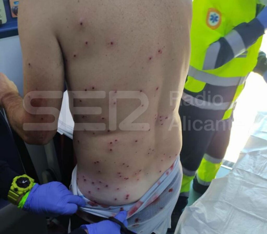 Así le quedó la espalda al ciclista que fue disparado por un cazador al confundirlo con un conejo en Alicante
